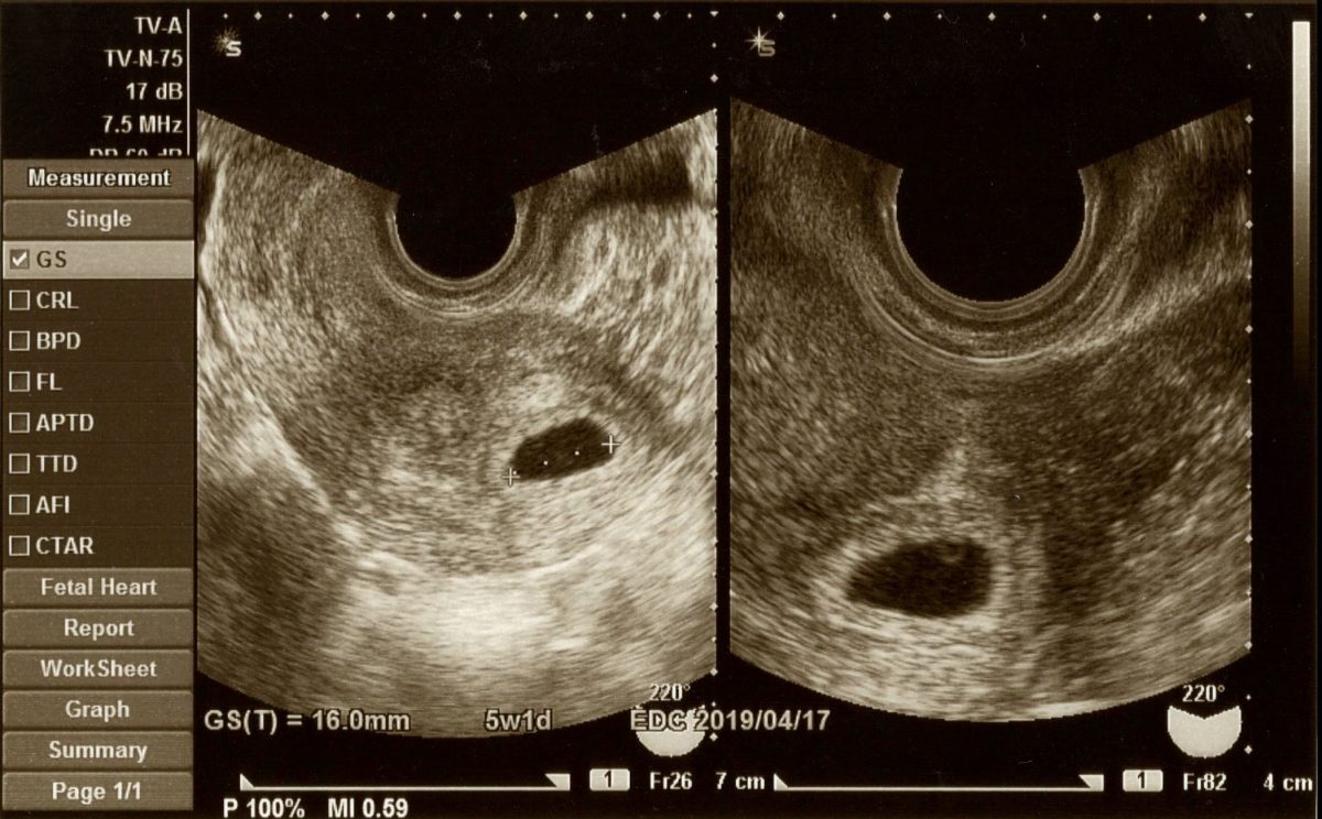卵巣のう腫 腹腔鏡手術体験ブログ